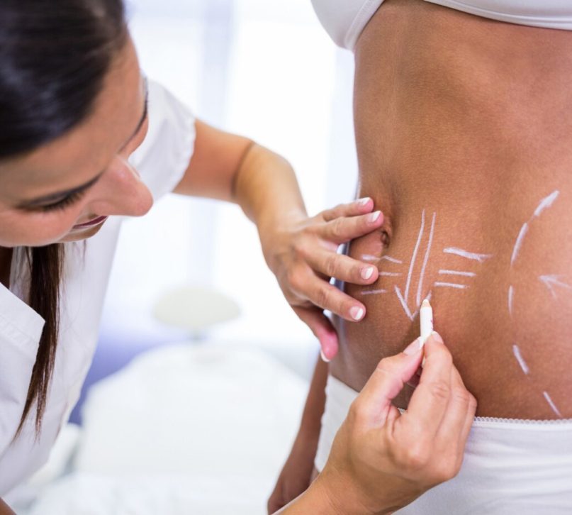 surgeon-drawing-lines-womans-abdomen-liposuction-cellulite-removal_107420-74083