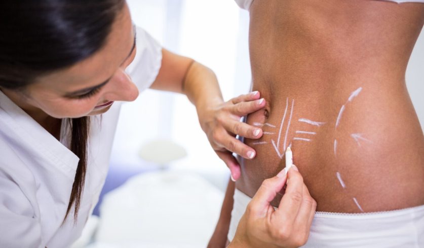 surgeon-drawing-lines-womans-abdomen-liposuction-cellulite-removal_107420-74083